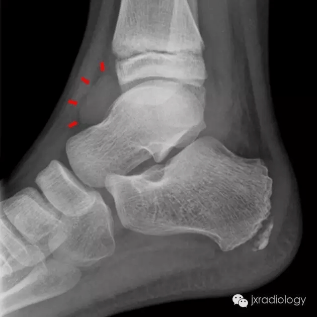 感染性關節炎synovitis 滑膜炎rheumatoid arthritis 類風溼關節炎