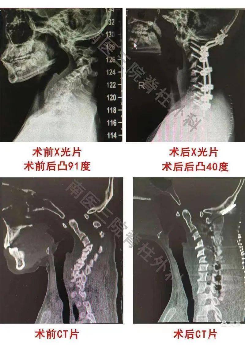 健康科普颈椎反弓到颈椎后凸畸形渐变到突变