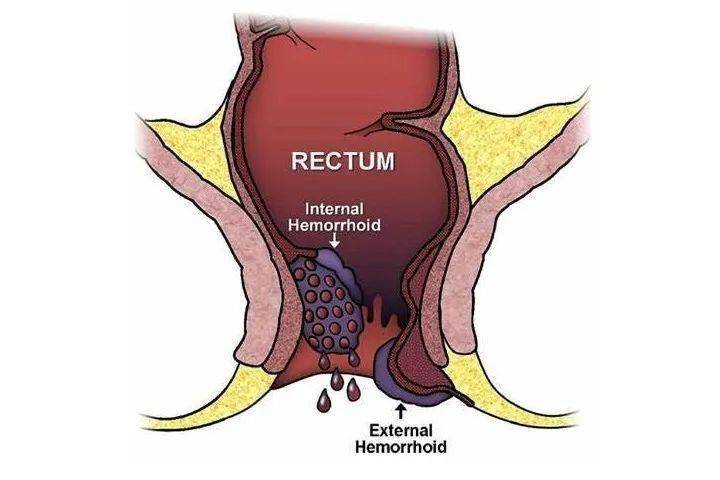 外痔伴有血栓形成,左后方的内痔表面充血水肿,粘膜糜烂伴有开放性裂口