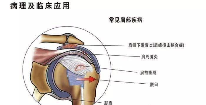 人体肩袖结构图图片