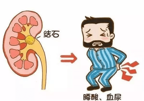 得了泌尿系统结石怎么办松江医生提醒你这4点很重要