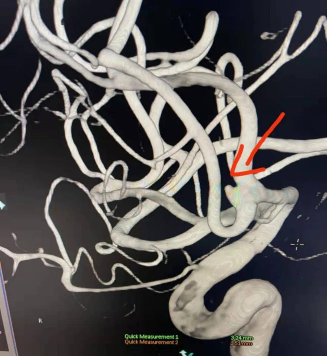 y型交叉支架技术辅助栓塞前交通宽颈微小动脉瘤