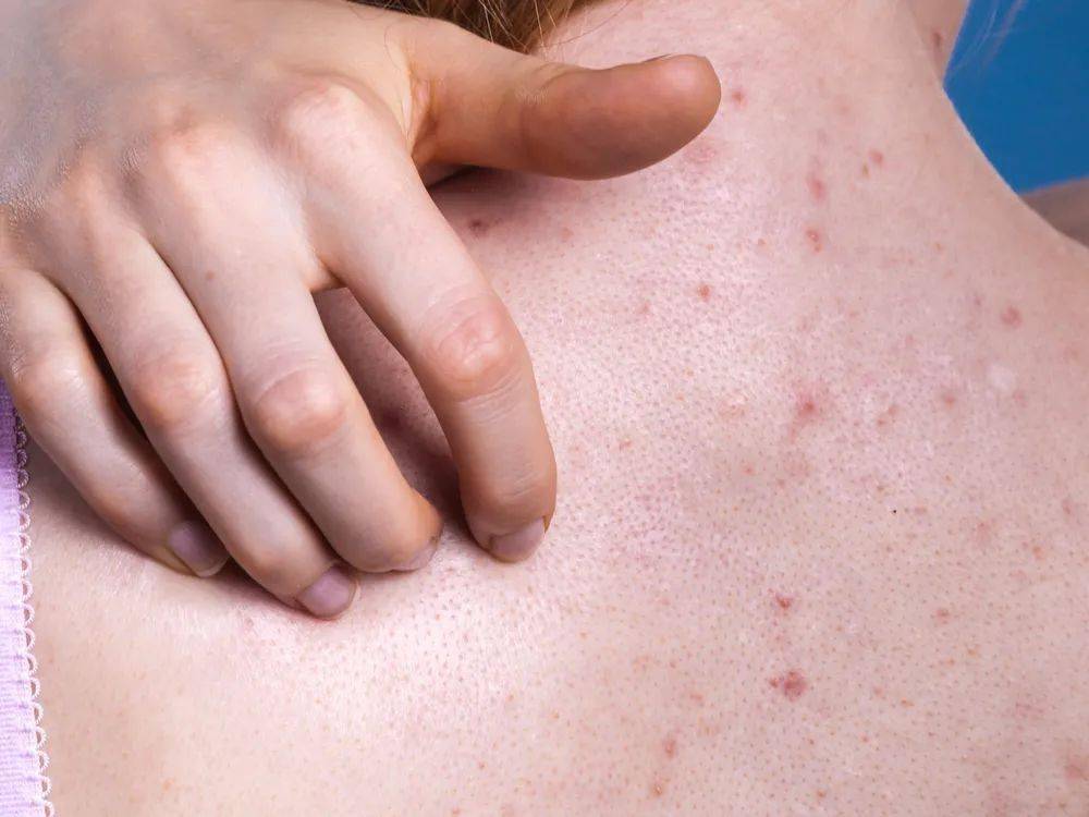 胸口长痘像鸡皮肤(胸口长鸡皮一样的痘痘怎么回事) 胸口长痘像鸡皮肤(胸口长鸡皮一样的痘痘怎么回事)