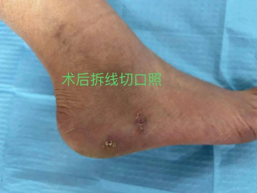 综上,关节镜下骨刺切除联合足底筋膜松解术治疗跟痛症具有手术切口小