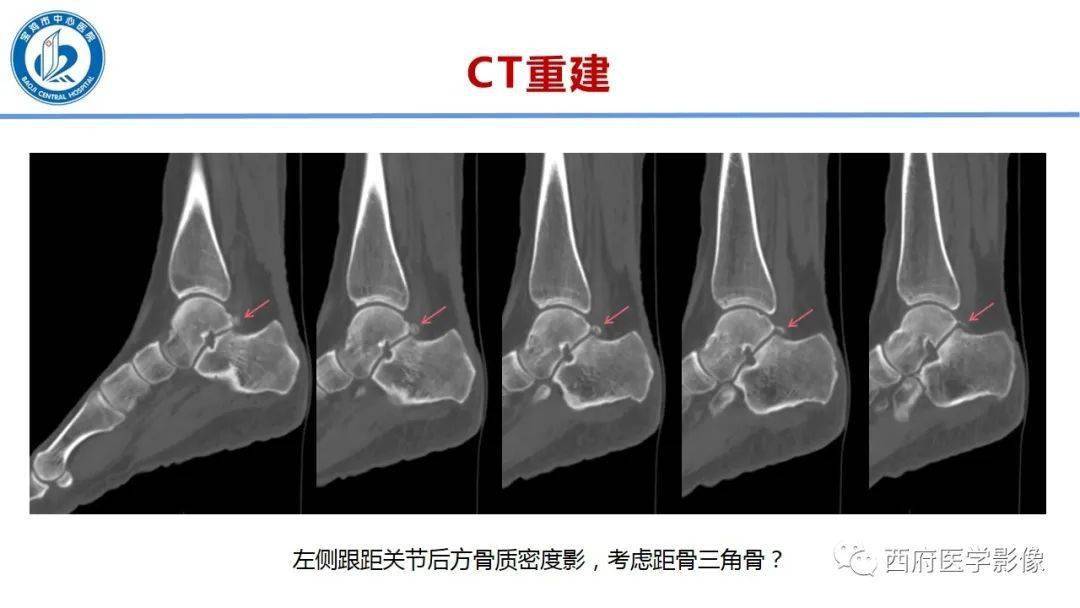 距后三角籽骨综合征影像诊断与鉴别诊断