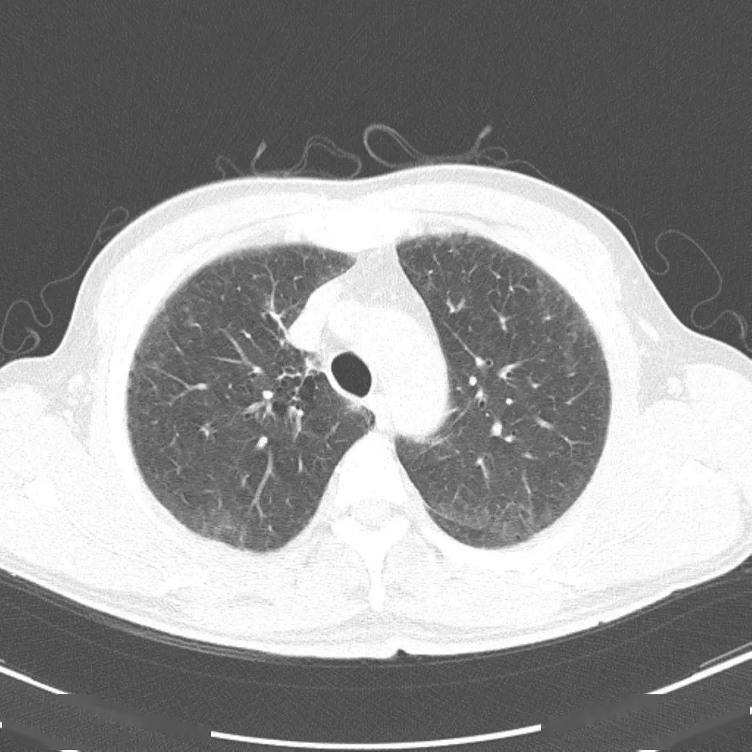 胸部|这个间质性肺炎，还挺少见的