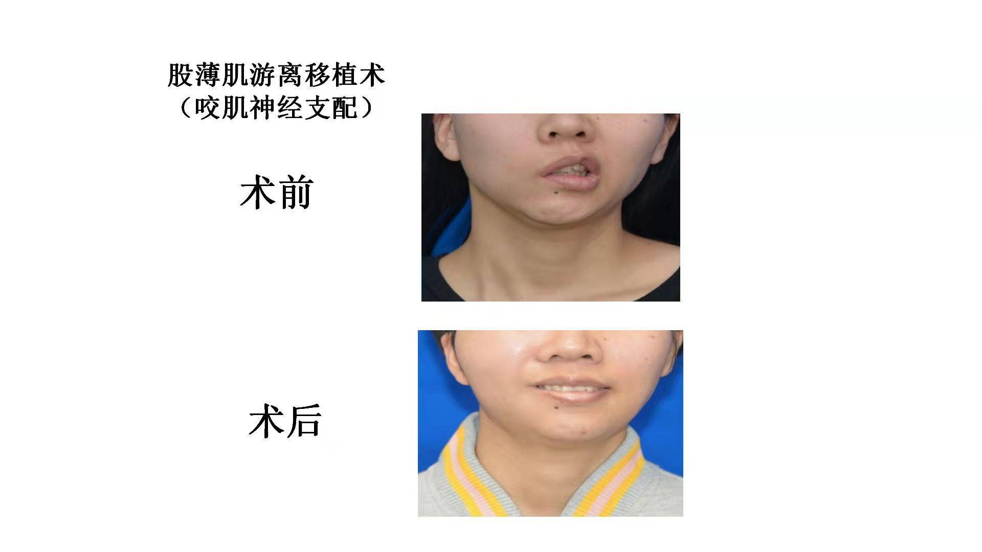 门诊来了一个小姑娘摘了口罩才发现竟是歪嘴面瘫年轻化能治吗