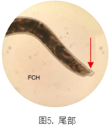 合并|一例分析 | 类风湿关节炎患者合并「钩虫感染」