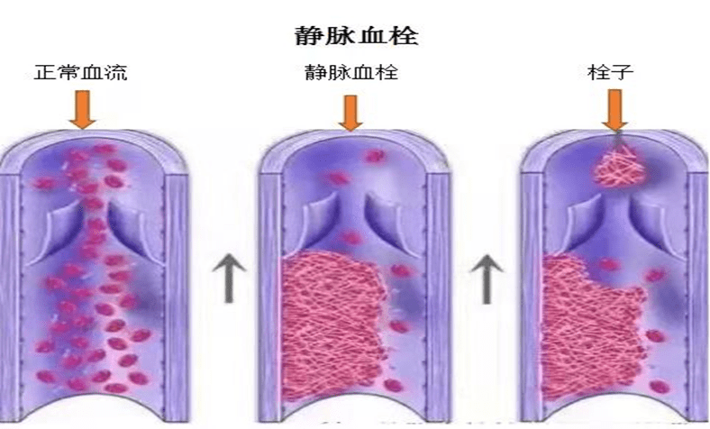 沉寂的“杀手”—静脉血栓栓塞症!_血液_活动量_血管
