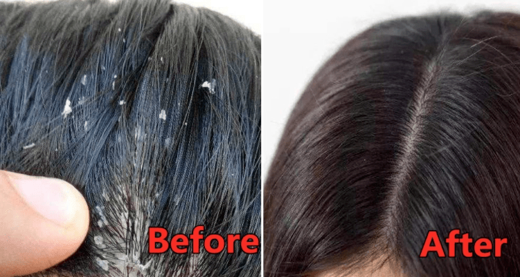 头皮头屑暴增？头皮扣下“白泥”？用Ta,帮你揪出头屑“内鬼”！清爽柔顺，发量翻一番！