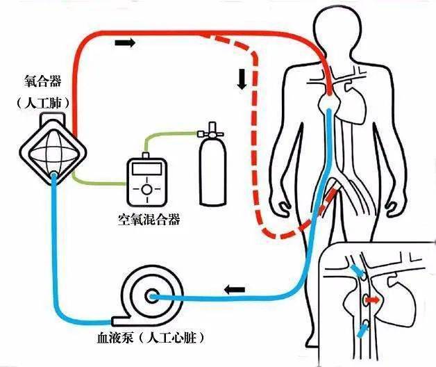 【人文】心血管手术中体外循环的那些事儿