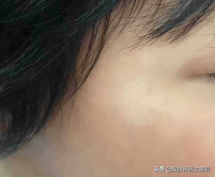 皮肤科医生和你聊聊:春天出现的"桃花癣",是怎么回事?