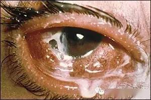 不同类型结膜病图文大汇总(学习贴,必须收藏)_分泌物_球菌_细胞