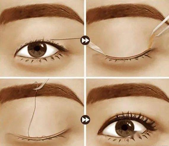 为什么睑缘切口双眼皮能做到睁眼有神闭眼无痕文末眼整形模特招募