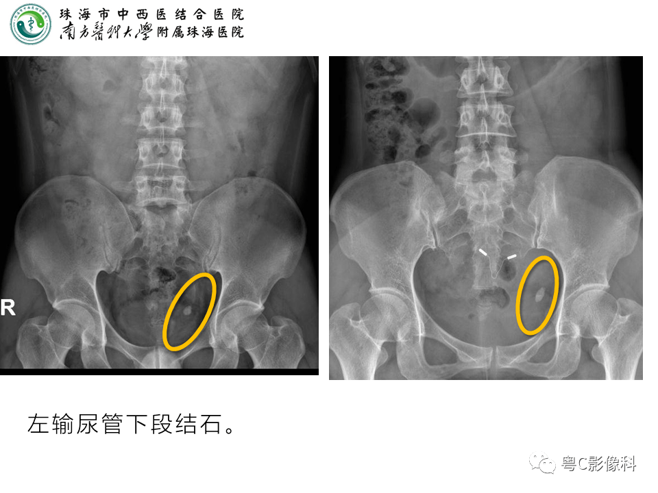 腹部液平面x线图片图片