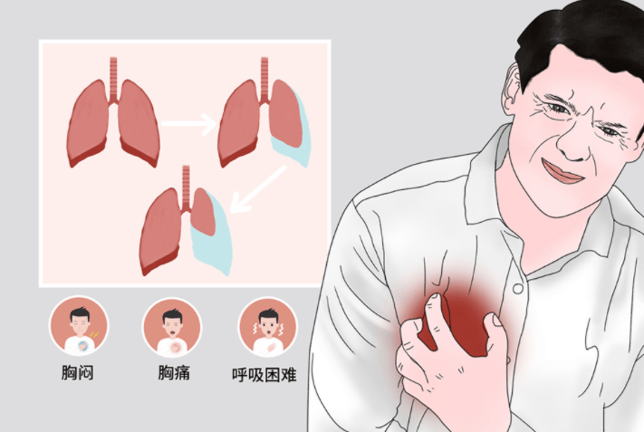 瘦高大帥哥運動後突發胸痛胸悶檢查發現肺破了