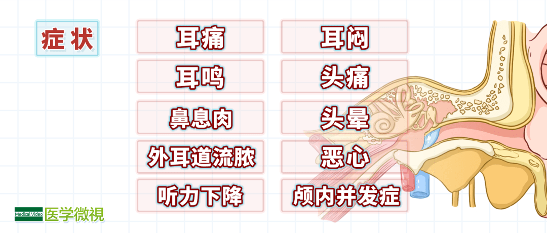 耳朵总是嗡嗡响伴有疼痛警惕这种可致聋的疾病