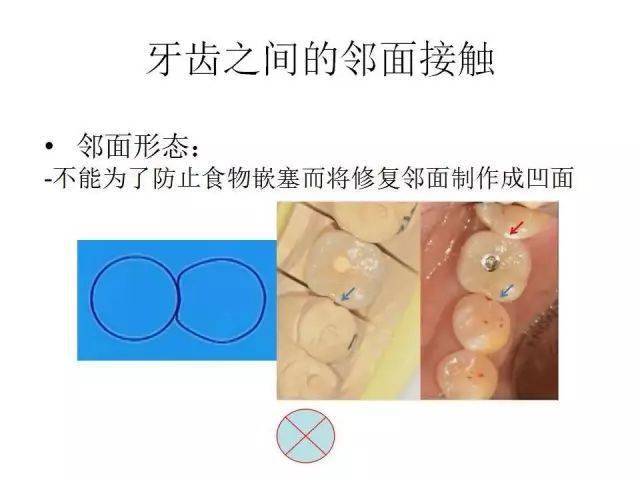 臨床上食物嵌塞問題解決方案高效實用