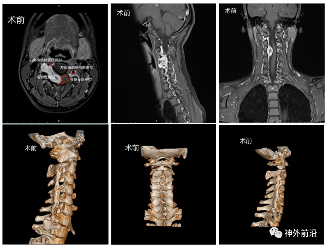 術前影像2個月前患者體檢時發現頸部強直,就診當地醫院行頸椎mri:約平