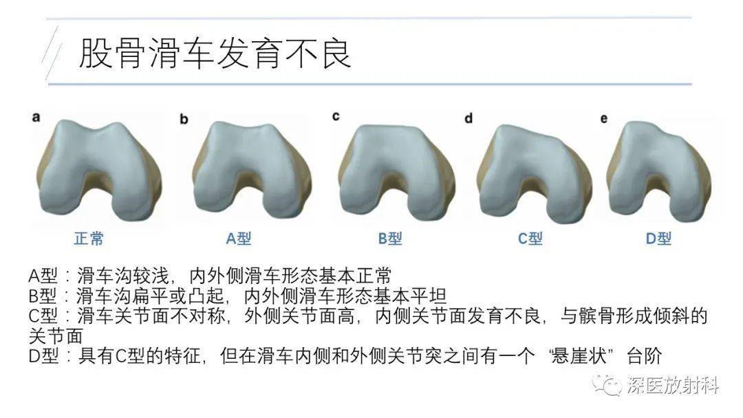 滑车关节面图片