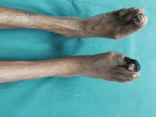 且无明显手术禁忌症,为保存患者肢体避免截肢及促进创面愈合我们遂给