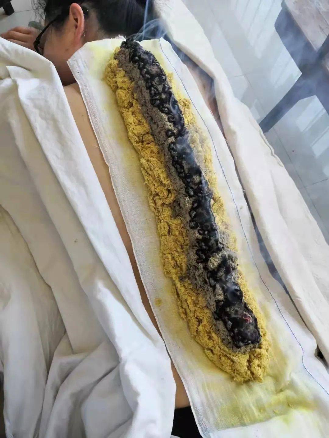 督脉灸项目二▲适用:各种痛症,痹症,痿证等.