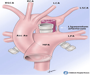 胎儿先天性血管环超声诊断及预后二右位主动脉弓