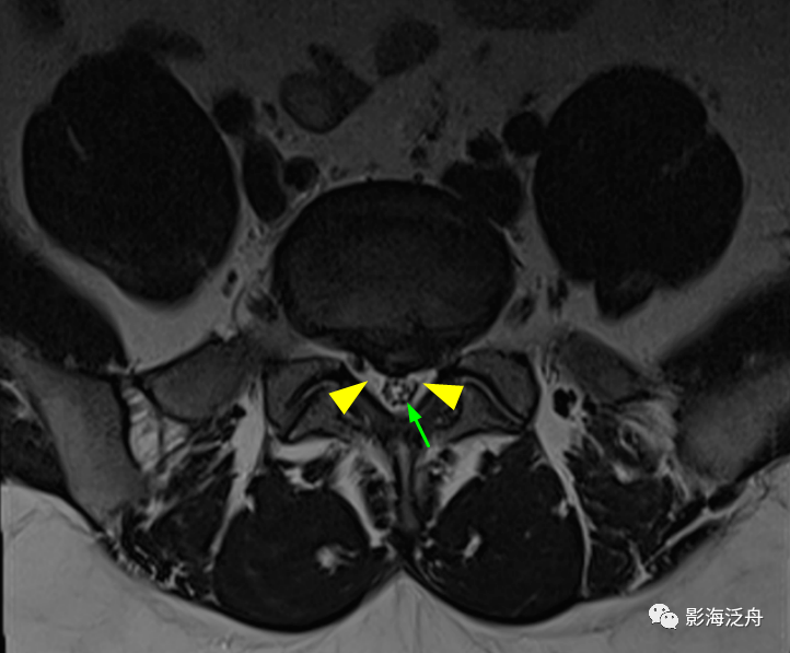 這個病,腰椎mr經常會漏診!_患者_解剖_馬尾