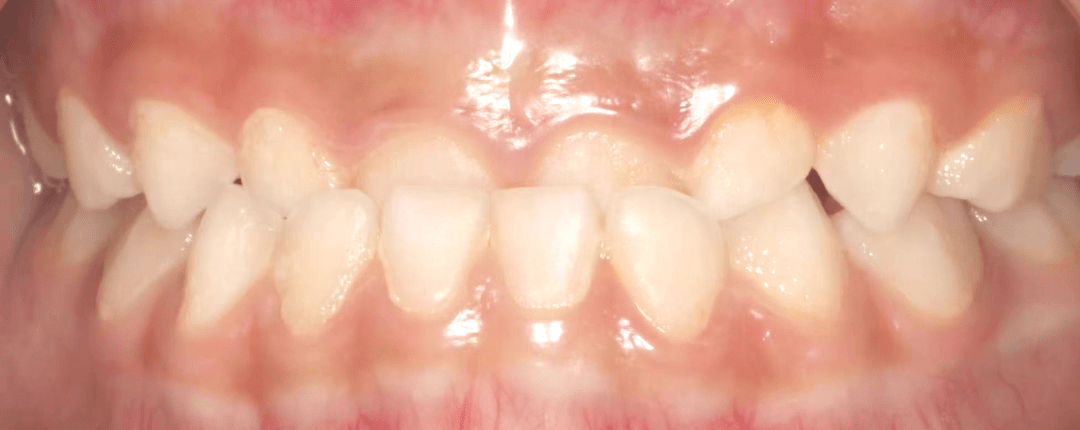 分 类包天,专业学术名词——反颌,牙齿上下咬合时,下排的牙齿盖在上排