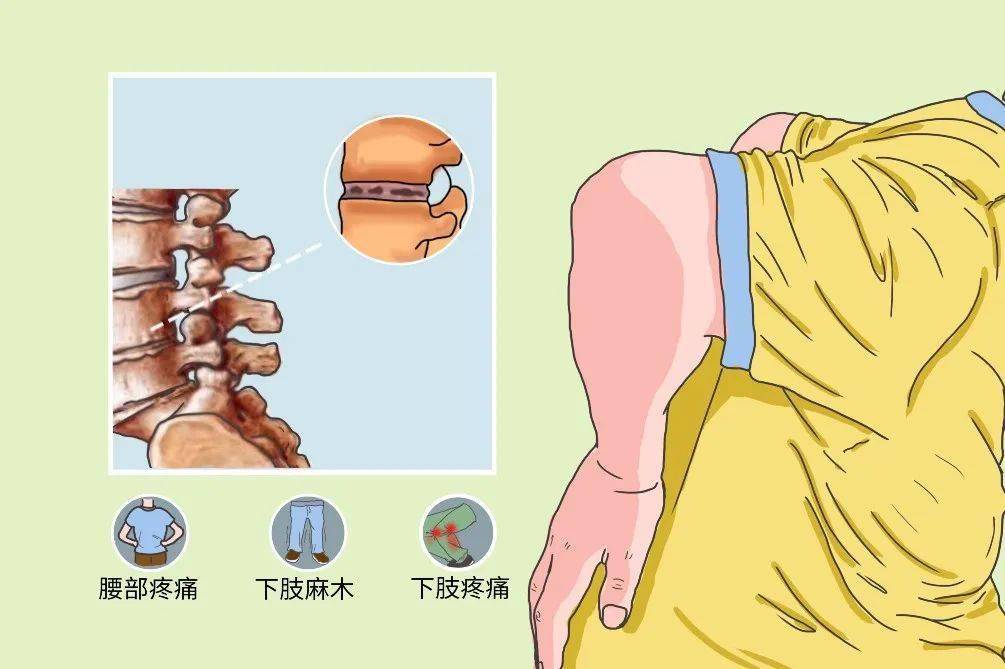 节目预告  82%的老年人都有腰椎病 专家教你这样自查