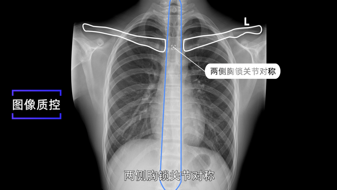 x线规范化检查胸部正侧位摄影