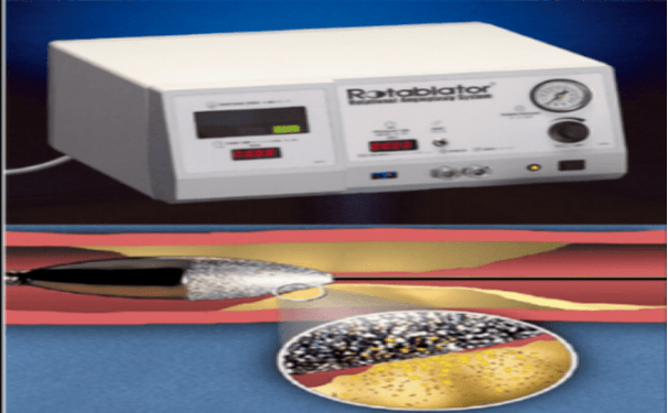 冠脉钙化病变的克星冠状动脉内斑块旋磨术