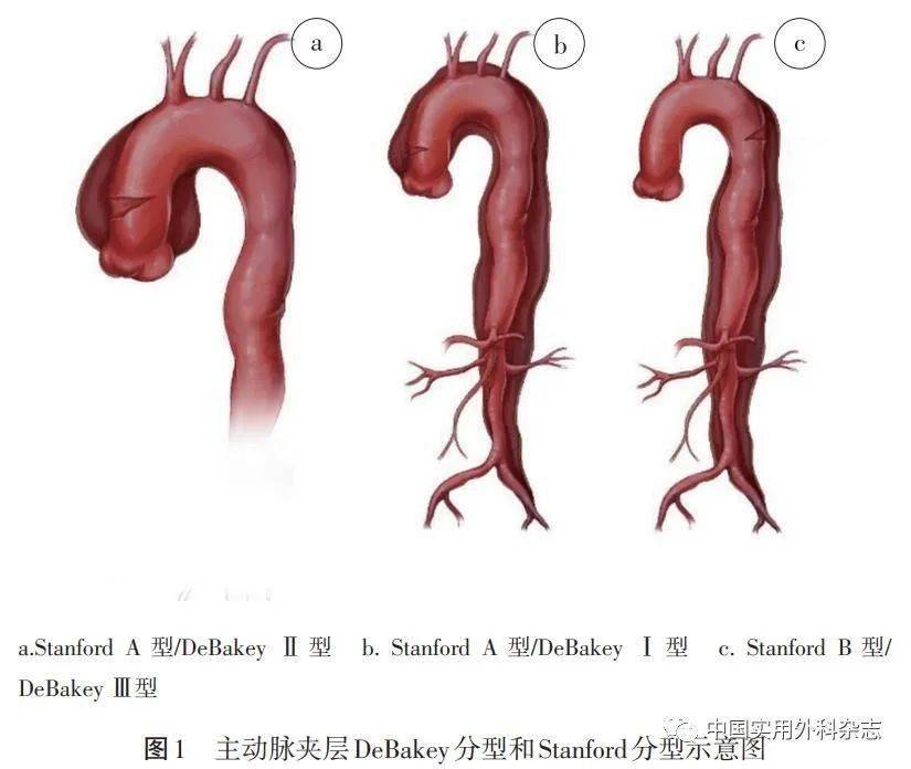 stanford分型图片