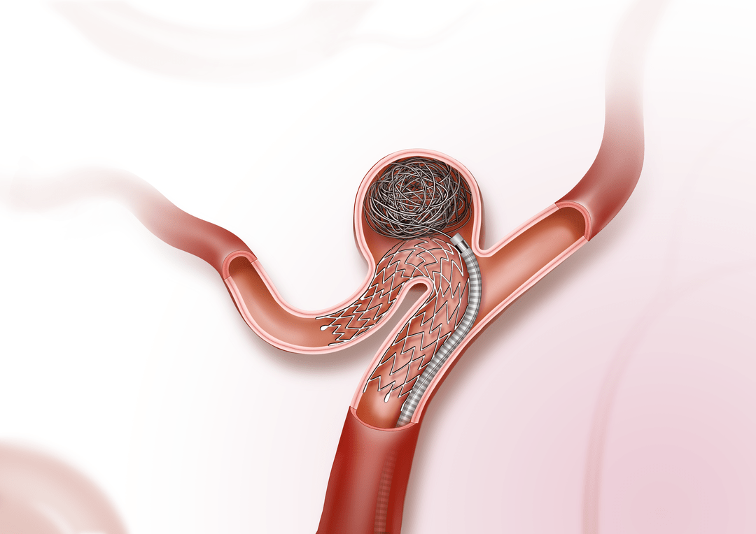 neuroform atlas支架作为一种小口径支架,由于可以通过0.