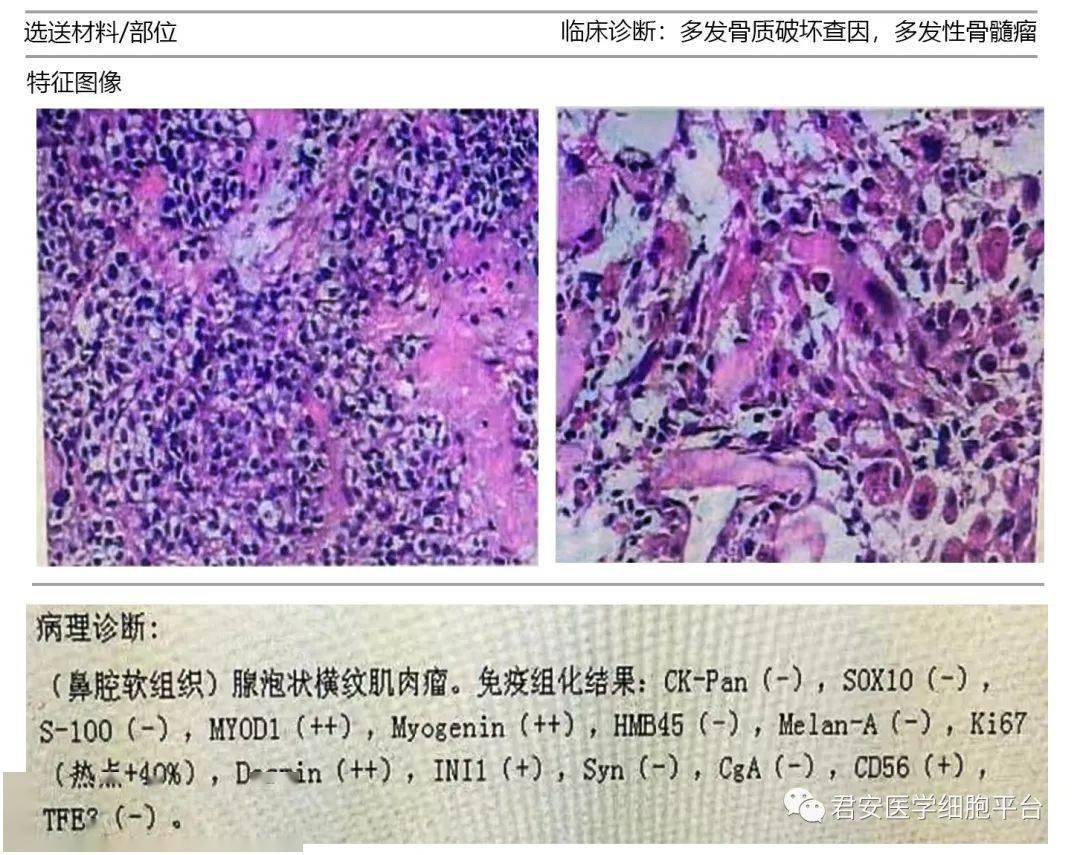 知識延伸腺泡狀橫紋肌肉瘤是高度惡性的小圓細胞腫瘤,病因與染色體