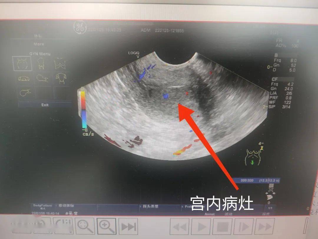 警惕絕經後惡臭液體流出以為陰道炎症半年後卻被確診癌症