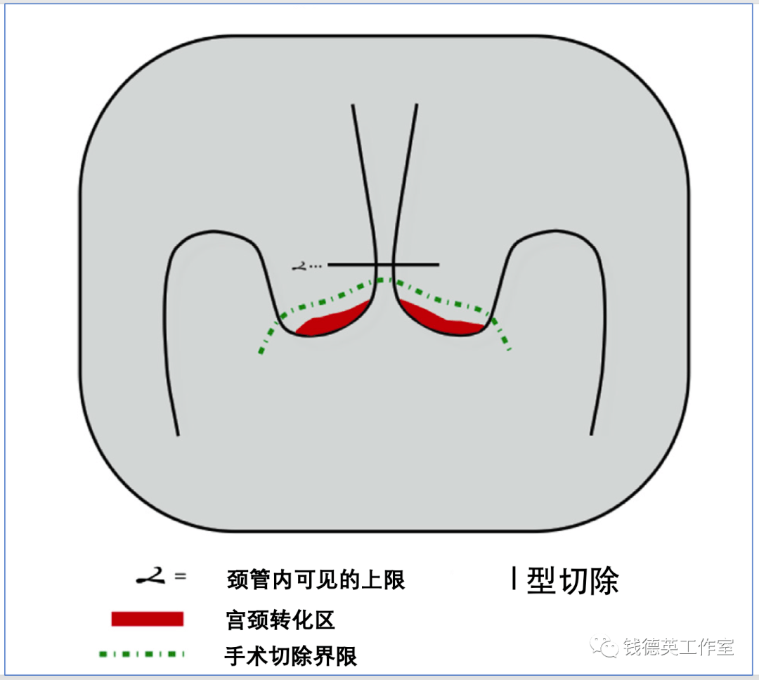 宫颈转化区2型图片图片