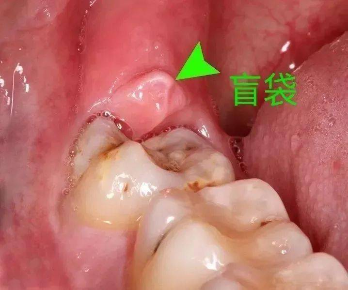 智齿的位置图片图片