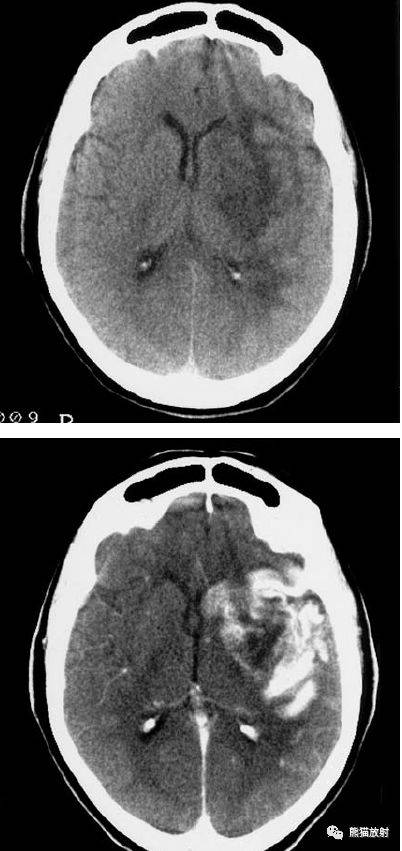 脑梗死影像学表现图片