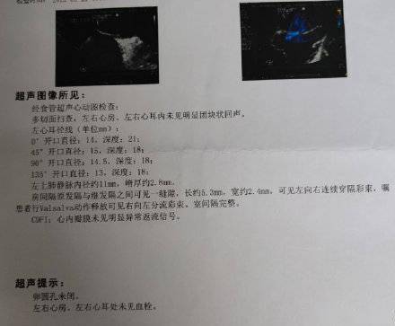 卵圆孔未闭,可及时通过介入封堵术进行治疗,治疗后不但能改善偏头痛