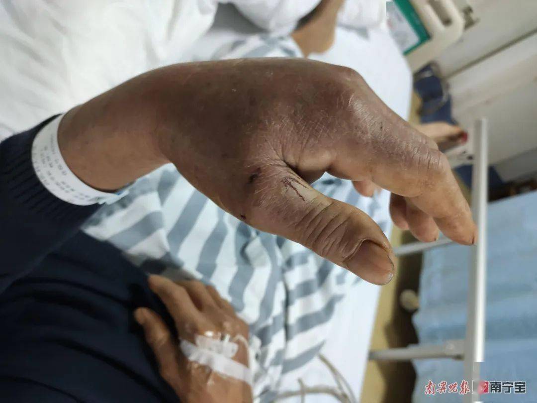 广西一村民干农活时被眼镜王蛇咬伤医生提醒被咬后这样做很重要