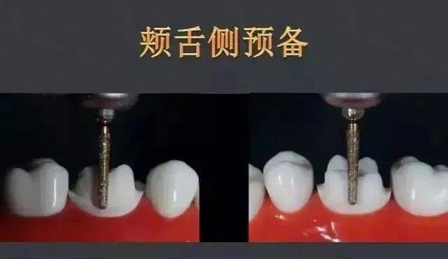 后牙嵌体预备步骤图片