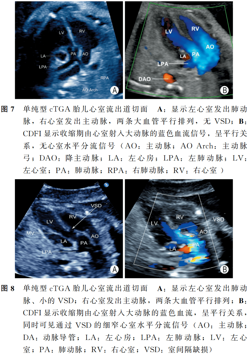 庆祝胎儿完全型大动脉转位中孕期超声检查中国专家共识2022版发布