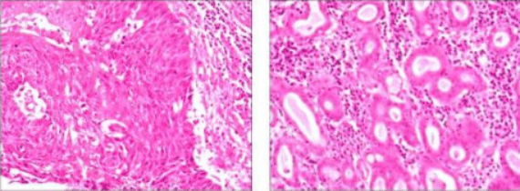 食管癌显微镜下图片图片