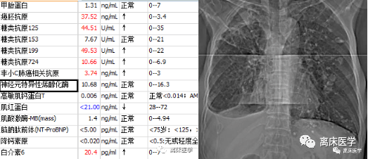 初步诊断:1.肺部阴影待查;2.胸腔积液.