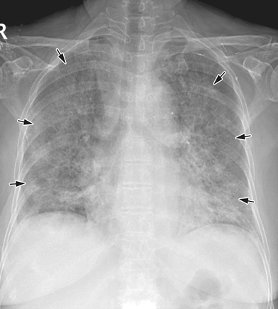 慢性支气管炎 胸片图片