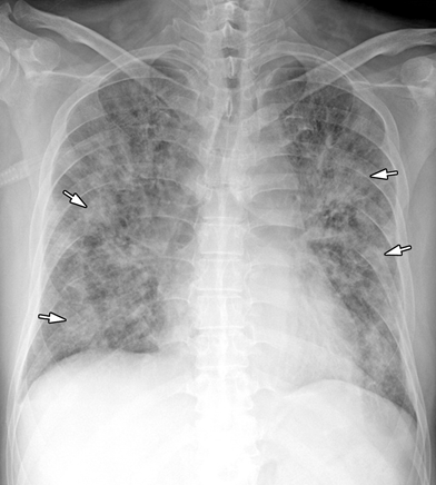 支气管肺炎影像图片图片