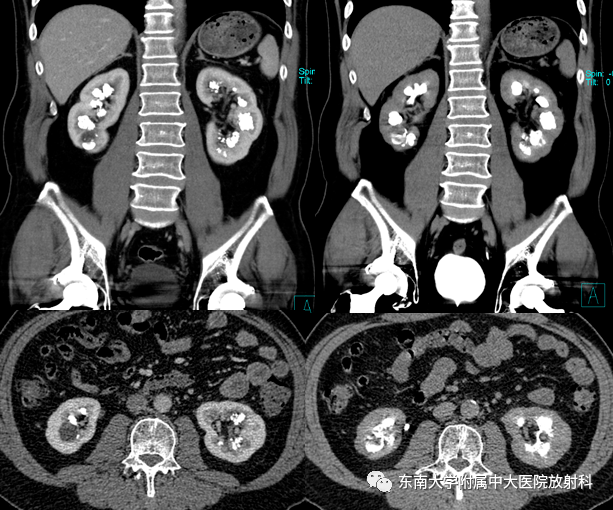 髓质海绵肾CT图片