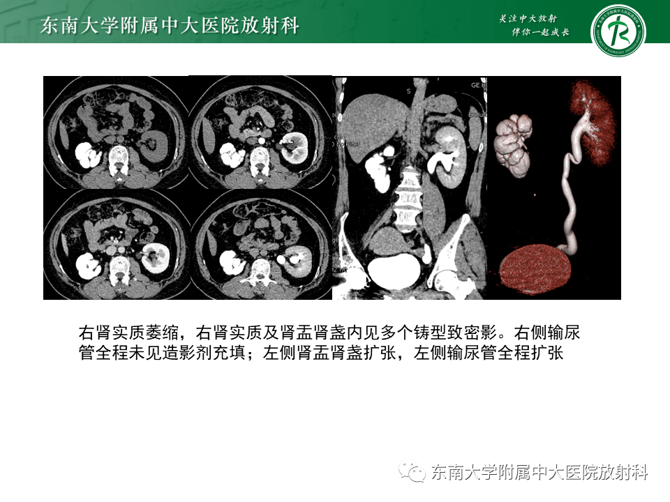 海绵肾影像图片