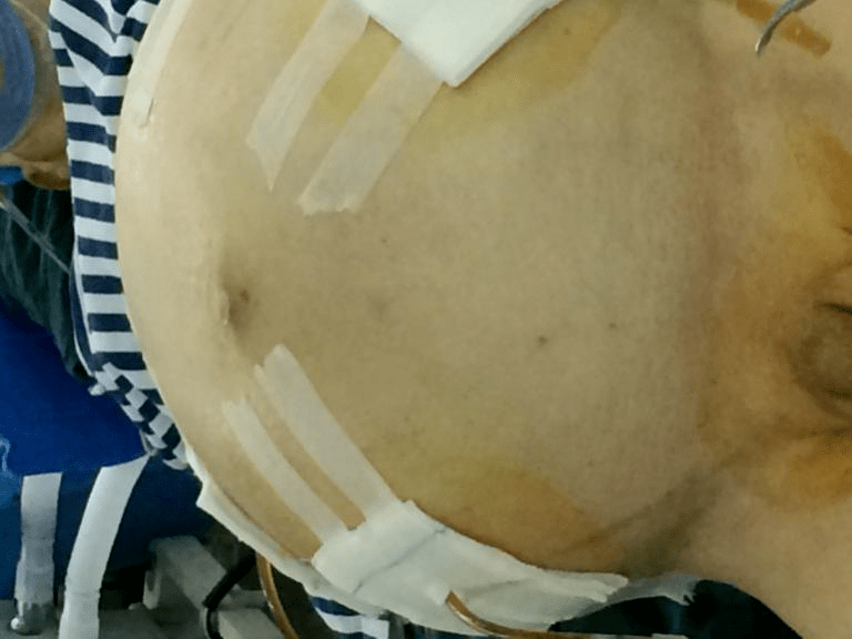 中的卵巢癌,子宫癌等,还有一部分来自于腹膜假性粘液瘤,腹膜间皮瘤等